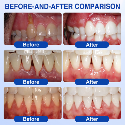 Pureluxo® 🦷GumRevive periodontal repair gel