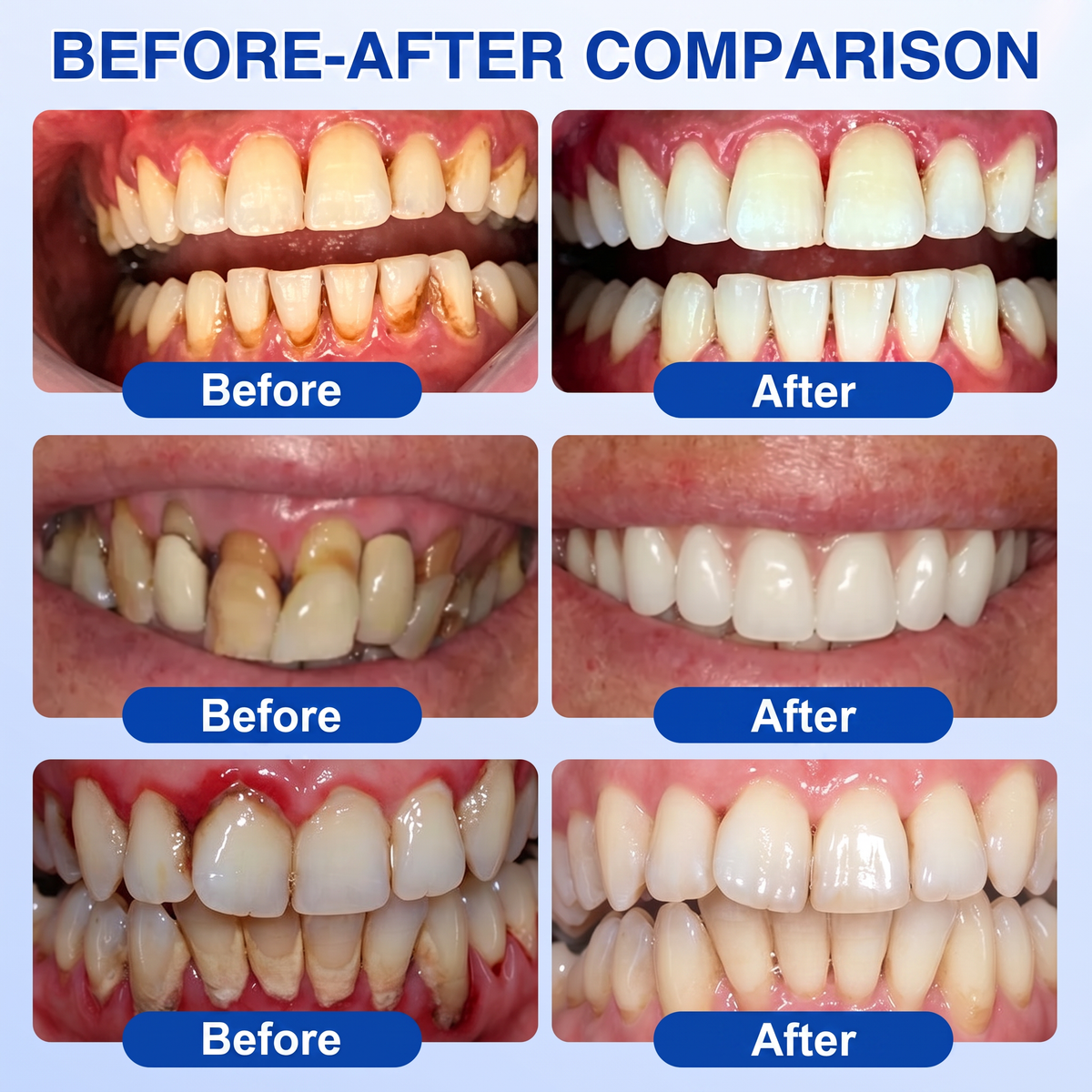Pureluxo® 🦷GumRevive periodontal repair gel
