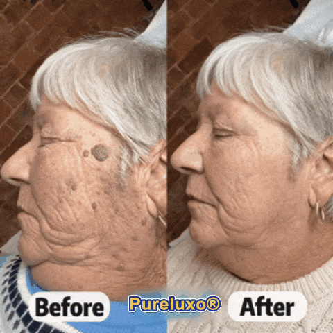 Pureluxo® Skin Tag Remover Roller💥💥💥