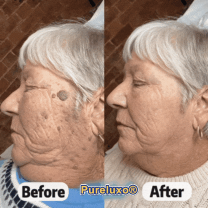 Pureluxo® Skin Tag Remover Roller💥💥💥