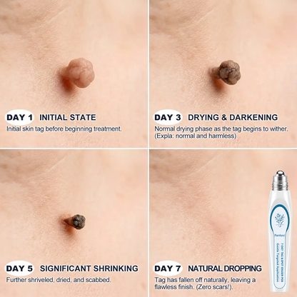 Pureluxo® Skin Tag Remover Roller💥💥💥